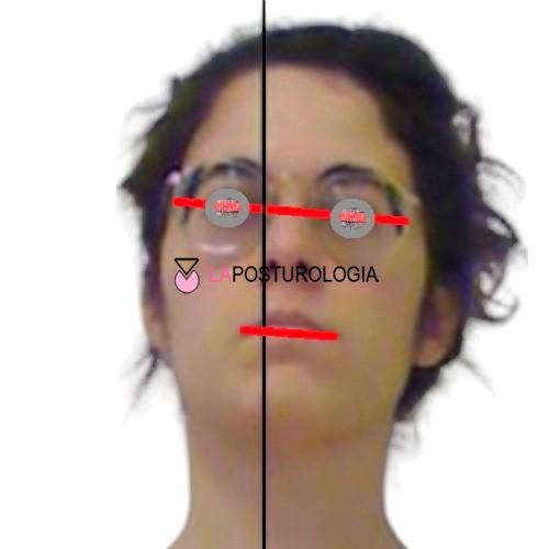 Analisi clinica computerizzata del piano bipupillare e occlusale in un paziente con posizione anomala del capo.