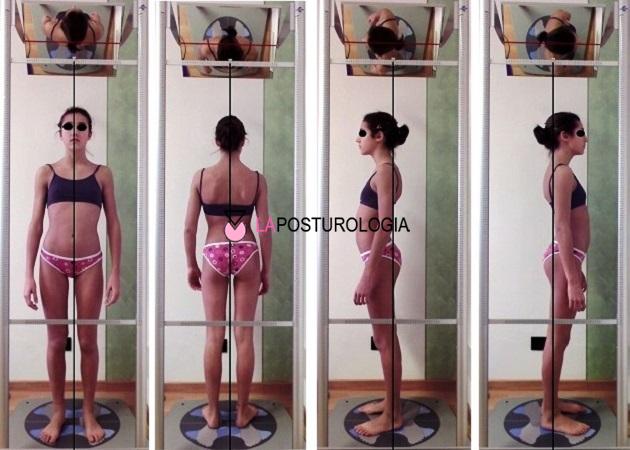 Esame posturale completo in quattro proiezioni su posturoscopio di una paziente di 13 anni con scoliosi dorso-lombare.