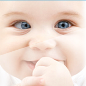 Primo piano del viso di un neonato con strabismo infantile convergente (esodeviazione dell'occhio).