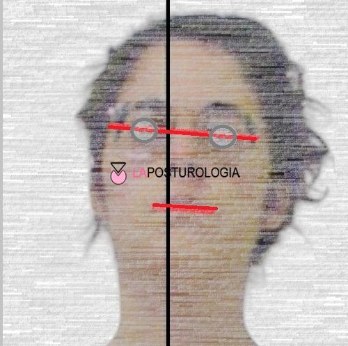 Analisi posturometrica del viso con asimmetria della linea bipupillare e del piano occlusale.