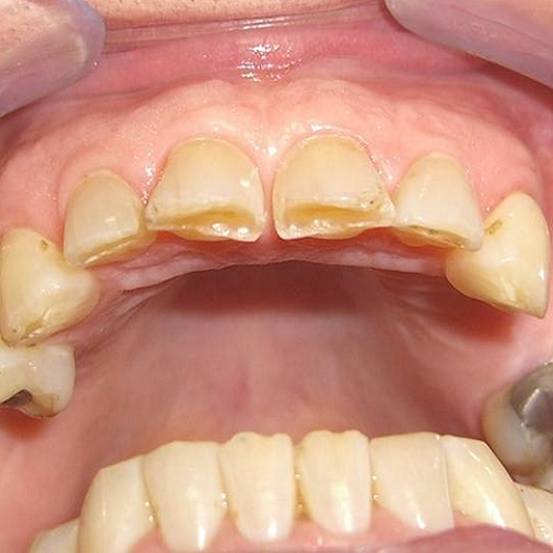 Bruxismo parafunzione che consiste nel digrignare i denti