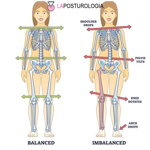 fografica comparativa sugli effetti della dismetria degli arti inferiori e della gamba corta sulla postura e sull'inclinazione del bacino.