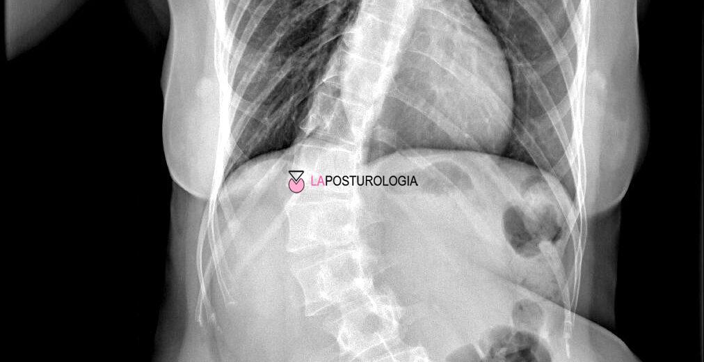 Radiografia della colonna vertebrale in toto che mostra una grave curva da scoliosi idiopatica in un paziente in età evolutiva