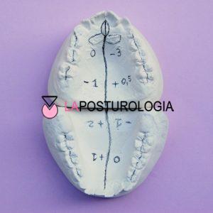 Calchi in gesso aperti con tracciati i parametri millimetrici di anteriorità, rotazione e asimmetria nella Squadratura Ortopedico Funzionale.