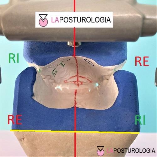 Studio in Fisiologia Cranica su modelli dentali in articolazione funzionale con evidenziazione grafica delle forze distorsive.