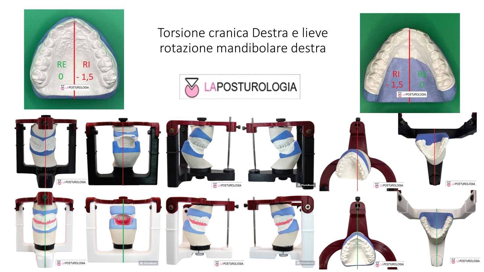 Torsione Cranica