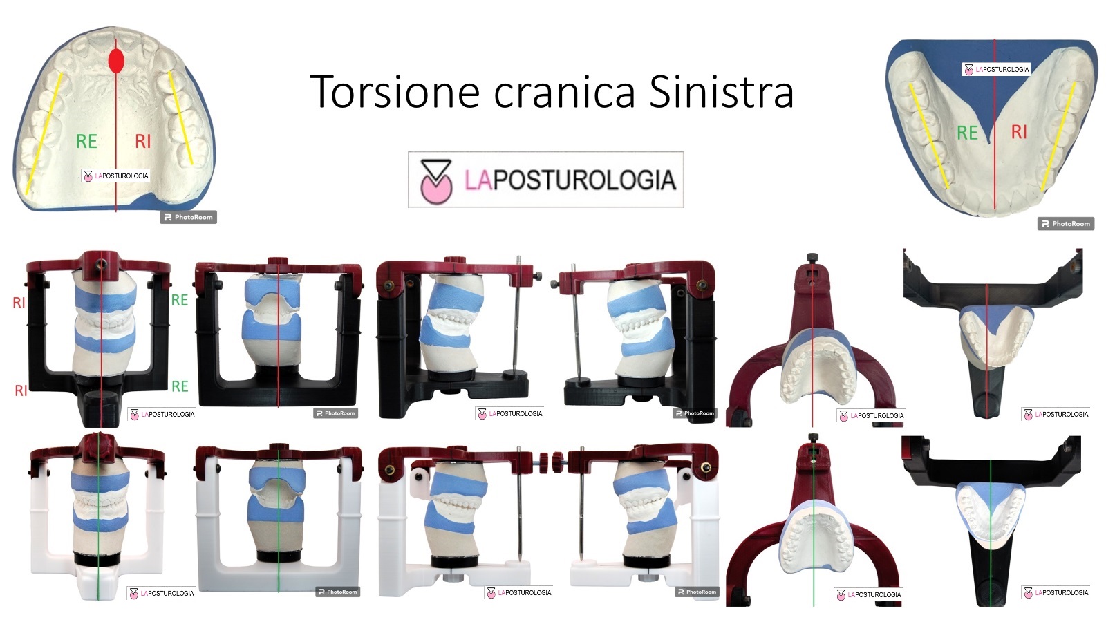 Torsione Cranica