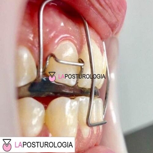 Foto clinica intraorale di un apparecchio ortopedico funzionale Simoes Network SN inserito in bocca.