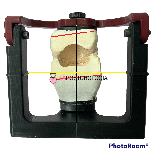 Modelli in gesso di un'arcata dentale posizionati in un articolatore per l'analisi dell'occlusione fisiologica e delle asimmetrie posturali.