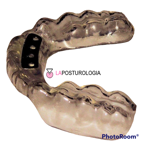 Bite dentale trasparente su misura con inserto anteriore per il riposizionamento cranio-mandibolare e la correzione della postura.