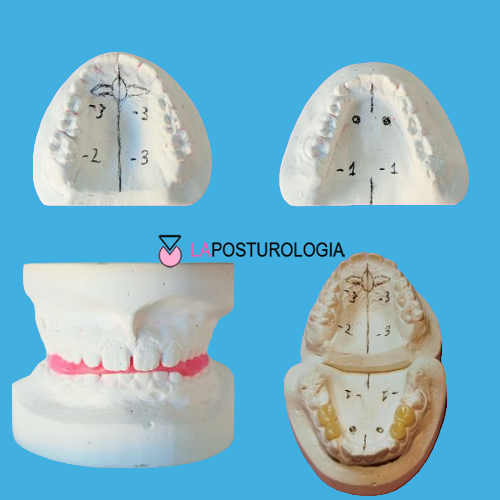 Modelli in gesso per lo studio diagnostico e la squadratura ortopedico funzionale SOF secondo la metodica di Pedro Planas.