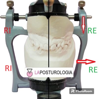 Modelli dentali in gesso montati su articolatore gnatologico per l'analisi delle asimmetrie occlusali RE e RI in posturologia.