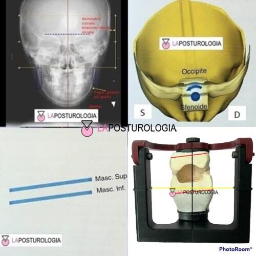 Analisi diagnostica delle asimmetrie del cranio, inclinazione del piano occlusale e correlazione con le vertebre cervicali.