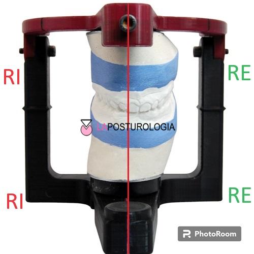 Modelli in gesso con Squadratura Ortopedico Funzionale montati in articolatore con evidenziate le linee di simmetria e rotazione interna ed esterna.