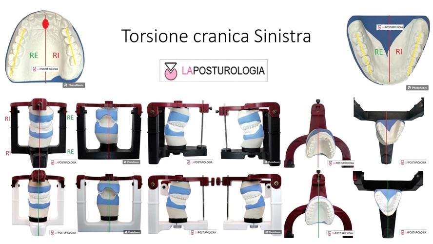 ografica dello stato di torsione cranica sinistra con modelli occlusali in gesso e analisi in articolatore.