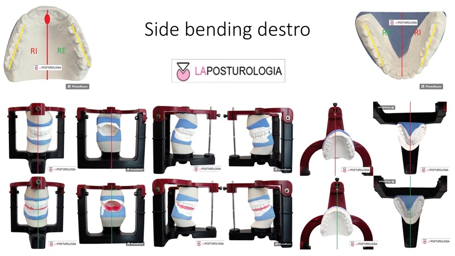 Infografica dello stato di side bending destro cranico con modelli occlusali in gesso e analisi in articolatore.