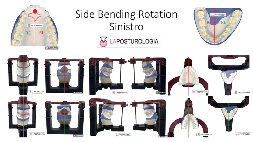 Infografica dello stato di side bending rotation sinistro con modelli occlusali in gesso e analisi in articolatore.