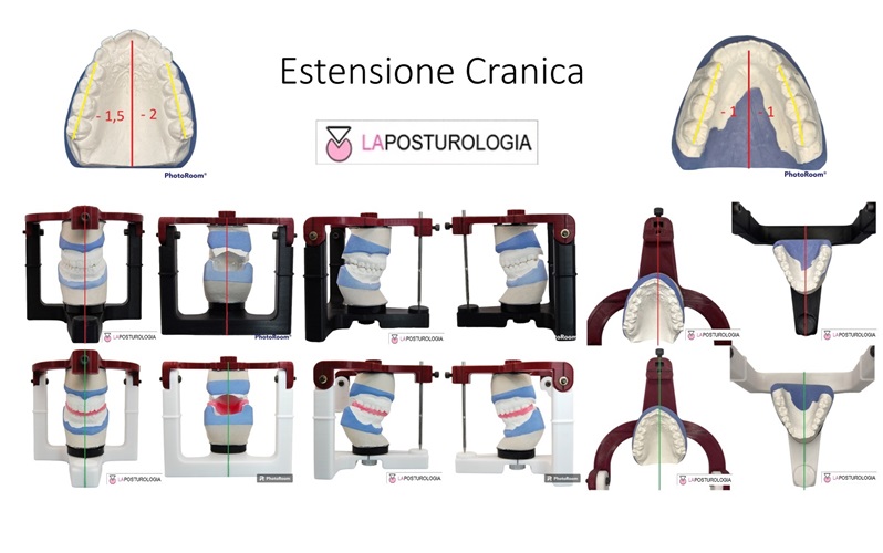 fografica dello stato di estensione cranica con modelli in gesso e analisi vettoriale in articolatore gnatologico.