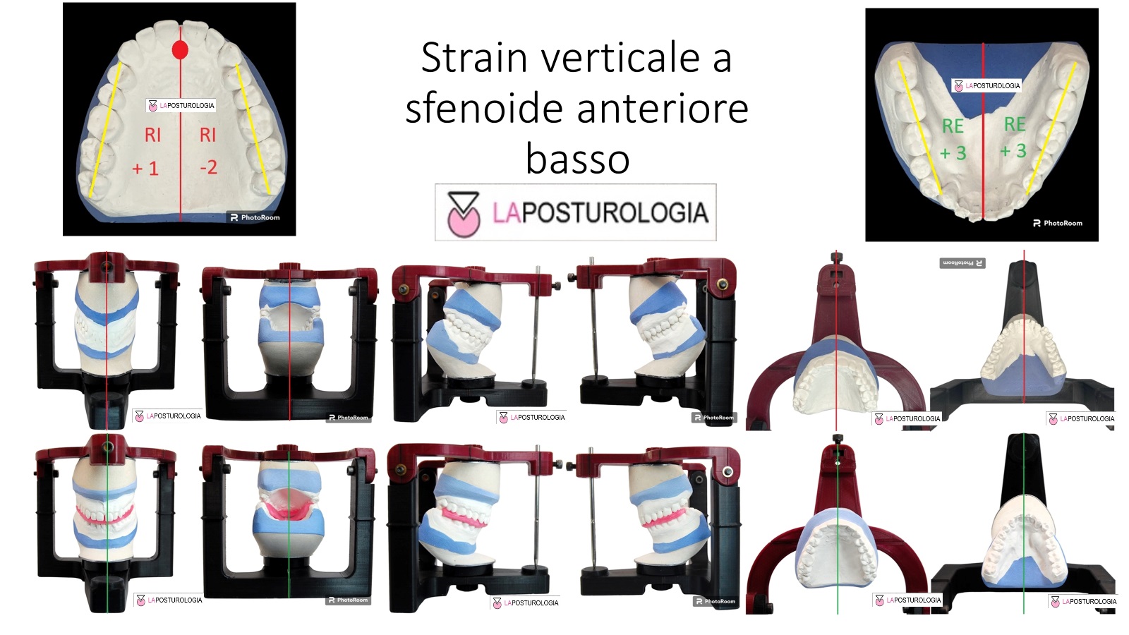 Strain Laterale