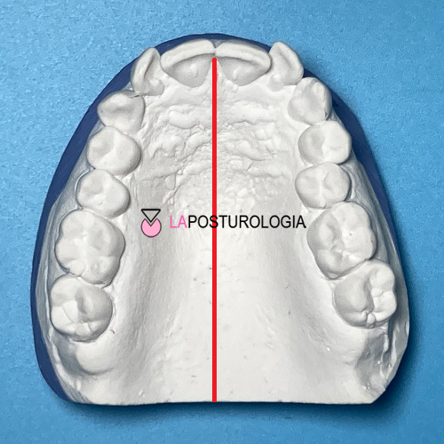 Calco in gesso dell'arcata dentale superiore con linea mediana per l'analisi posturologica delle asimmetrie palatali e occlusali.