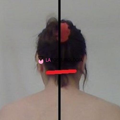 Analisi clinica computerizzata delle tensioni cervicali a livello occipitale (C0) ed atlo-assiale (C1-C2) su un paziente con capelli scuri