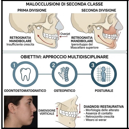 fografia clinica quadrata sulle malocclusioni di seconda classe prima e seconda divisione e i quattro pilastri del trattamento multidisciplinare.