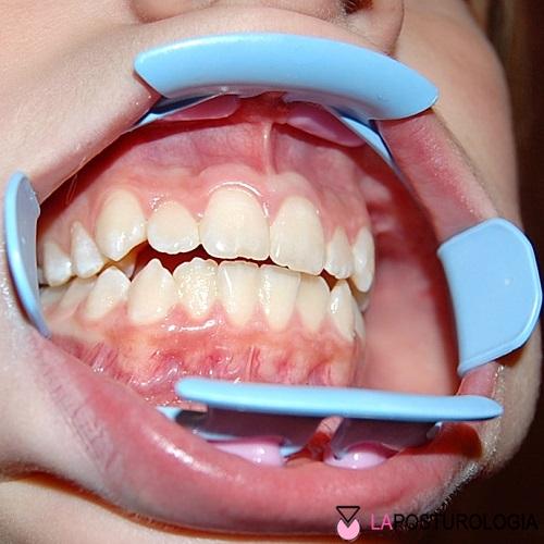 Foto clinica intraorale di un morso aperto anteriore in un paziente giovane, che mostra la mancanza di contatto verticale tra gli incisivi.