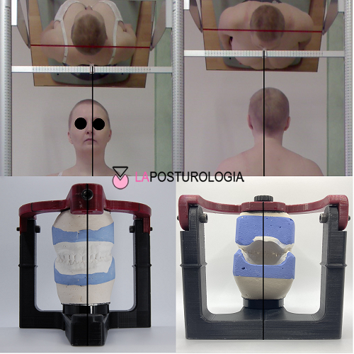 Analisi integrata delle asimmetrie posturali della testa e delle spalle in correlazione con la torsione dei modelli occlusali in articolatore.