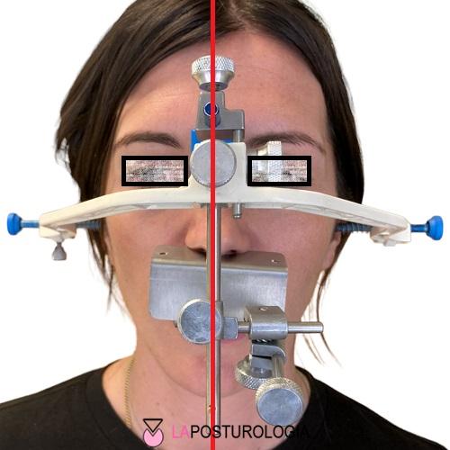 Applicazione clinica dell'arco facciale di trasferimento per la registrazione tridimensionale dei piani cranio-occlusali rispetto alla linea mediana.