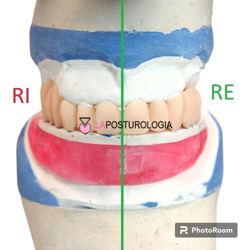 Modelli in gesso con valli occlusali in cera e allineamento della linea mediana verticale per il controllo gnatologico e posturale.