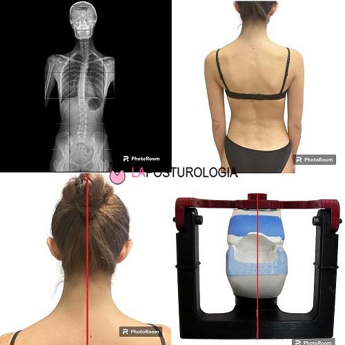 Collage clinico che mostra la correlazione tra asimmetria occlusale tridimensionale, disallineamento del capo e scoliosi dorsolombare.