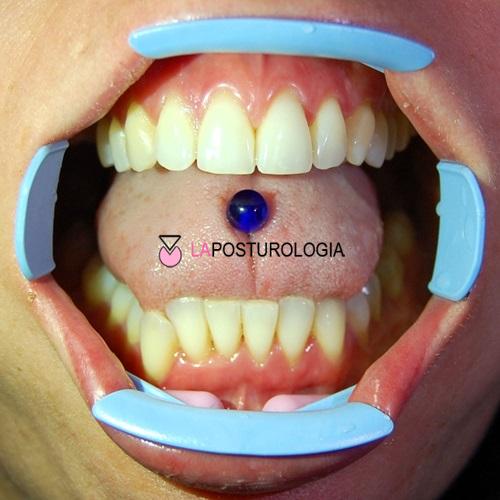 Fotografia clinica intraorale con divaricatore labiale che mostra un piercing sferico blu posizionato sulla lingua.
