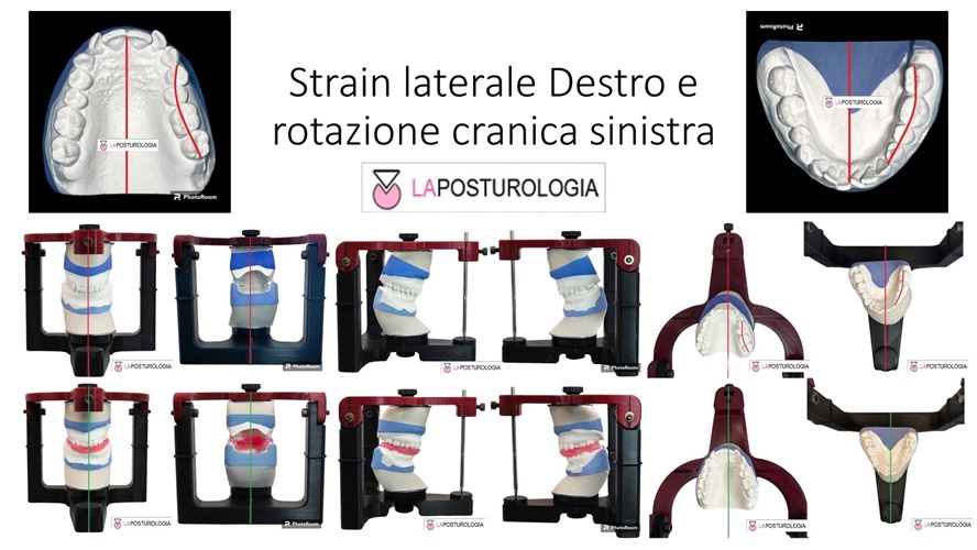 fografica di strain laterale destro combinato con rotazione cranica sinistra, modelli occlusali e articolatore.