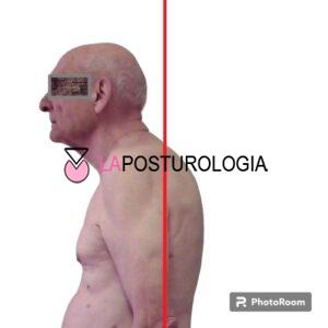 iperlordosi cervicale iperlordosi cervicale