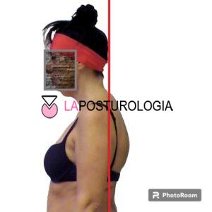 iperlordosi cervicale iperlordosi cervicale
