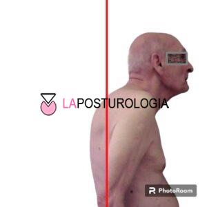 iperlordosi cervicale iperlordosi cervicale