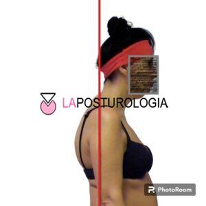 iperlordosi cervicale iperlordosi cervicale