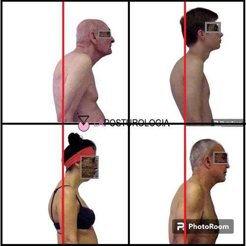 Esempi clinici di protrazione del capo in avanti e iperlordosi cervicale analizzati sul piano sagittale.