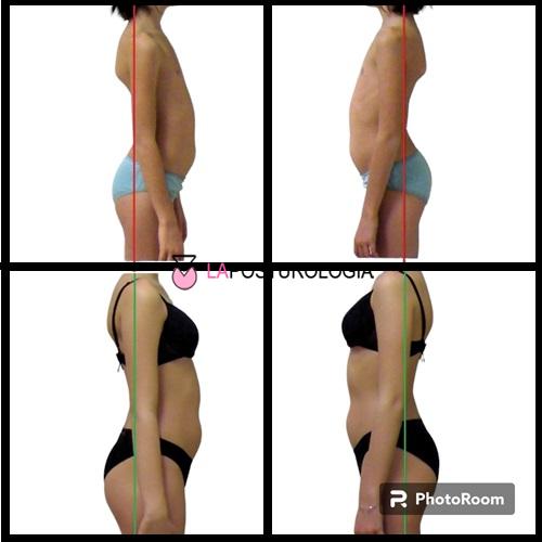 Confronto fotografico di profilo che mostra la correzione clinica di un'iperlordosi lombare e il riallineamento del baricentro corporeo.