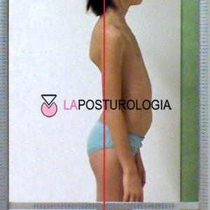 Lordosi e Iperlordosi Lordosi e Iperlordosi