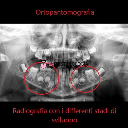 Ortopantomografia pediatrica con evidenziati i differenti stadi di sviluppo dentale e la permuta degli elementi decidui.