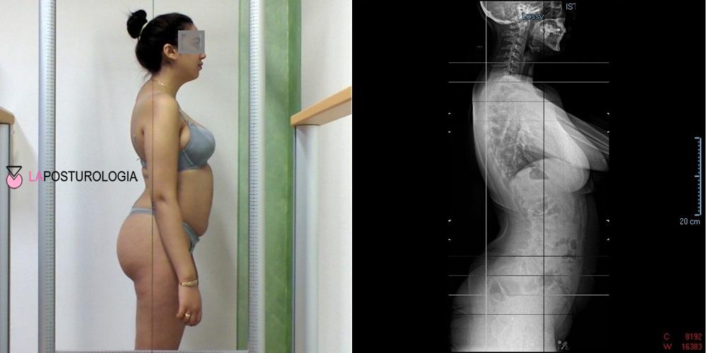 Valutazione posturale e radiografia della colonna vertebrale per la diagnosi di iperlordosi lombare.