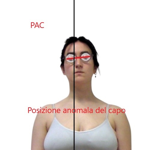 Valutazione posturale della Posizione Anomala del Capo (PAC) con asse bipupillare inclinato rispetto alla linea mediana.